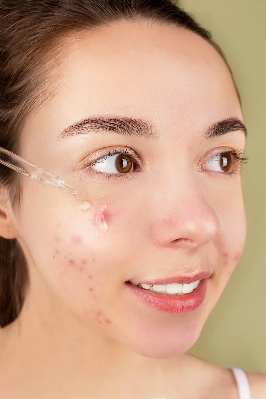 morning acne skincare